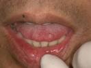 舌癌１.jpg