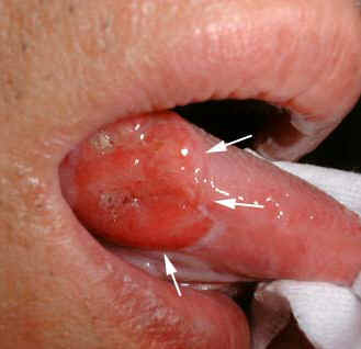 舌癌２.jpg